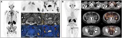 Optimized Application of 68Ga-Prostate-Specific Membrane Antigen-617 Whole-Body PET/CT and Pelvic PET/MR in Prostate Cancer Initial Diagnosis and Staging